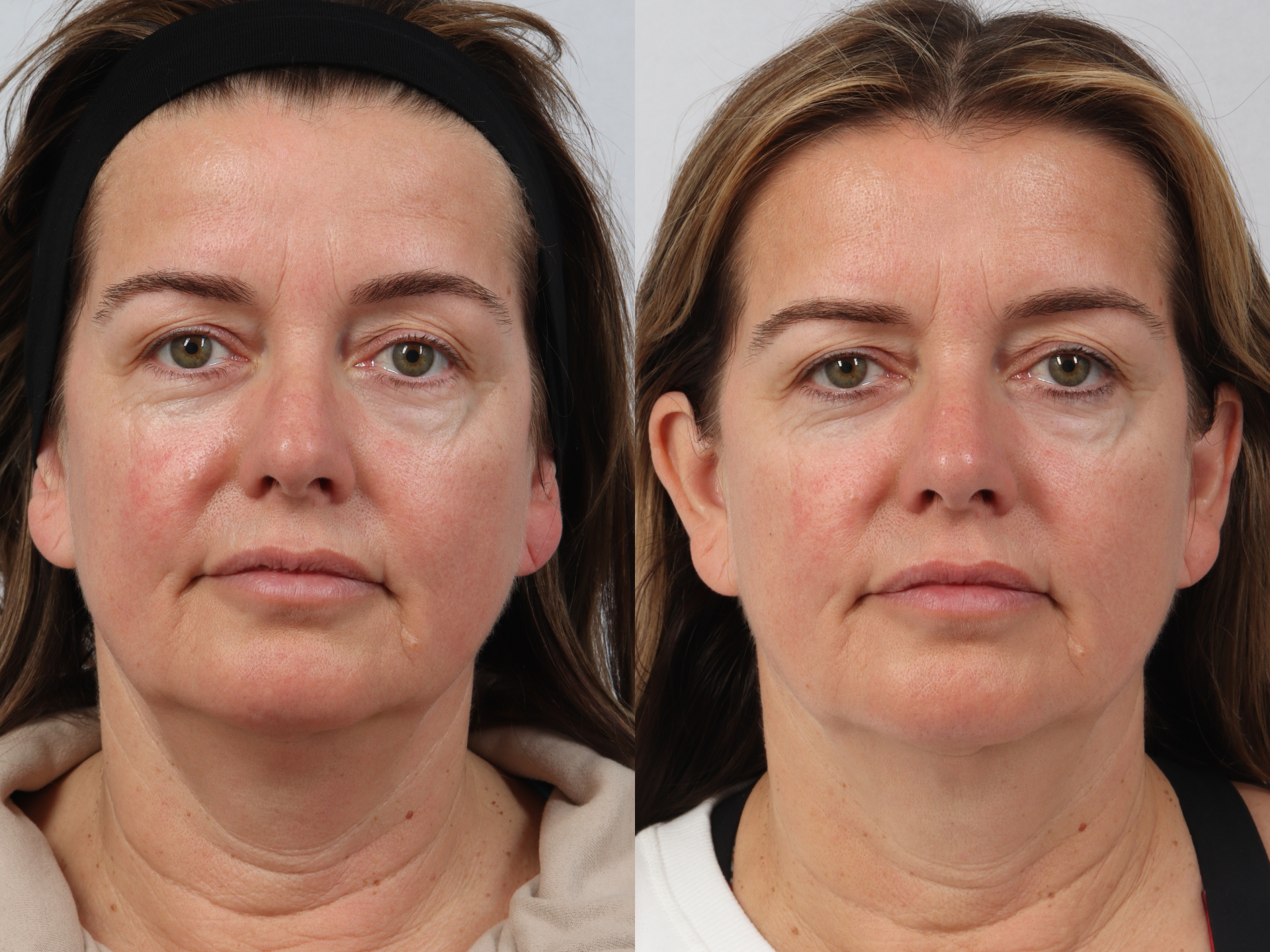 Before and after — age 39, ​